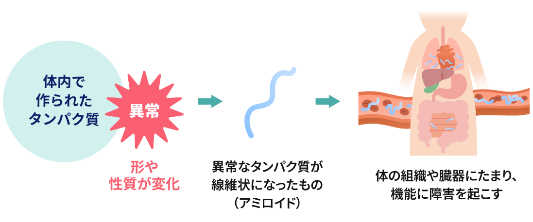 アミロイドーシスとは