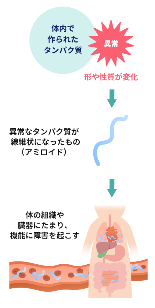アミロイドーシスとは