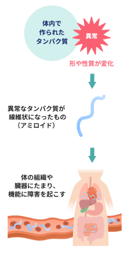 アミロイドーシスとは